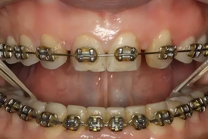 正畸牵引勾放置位置有何讲究？-图1