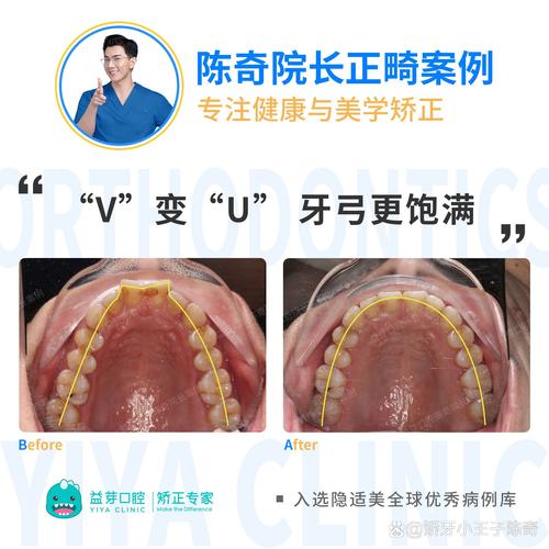 上海牙齿正畸在线咨询怎么操作？效果靠谱吗？-图2