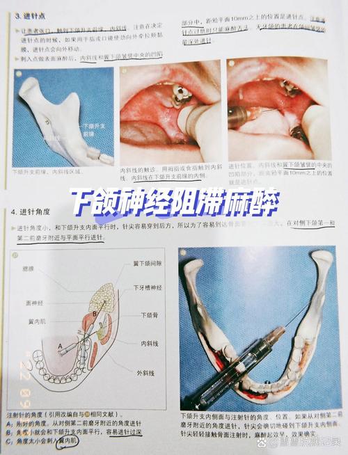 颌外局部麻醉常用方法及操作要点是什么？-图1