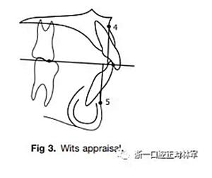 正畸Wits值正常值具体范围是多少?-图1 正畸Wits值正常值具体范围是多少?-图1
