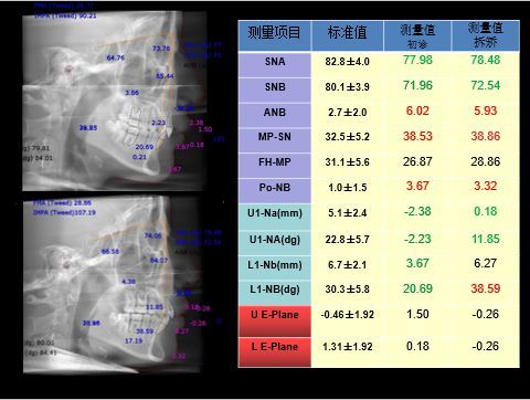 正畸Wits值正常值具体范围是多少?-图3 正畸Wits值正常值具体范围是多少?-图3