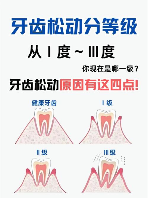 种植牙松动会掉落吗?脱落风险大吗?-图3 种植牙松动会掉落吗?脱落风险大吗?-图3