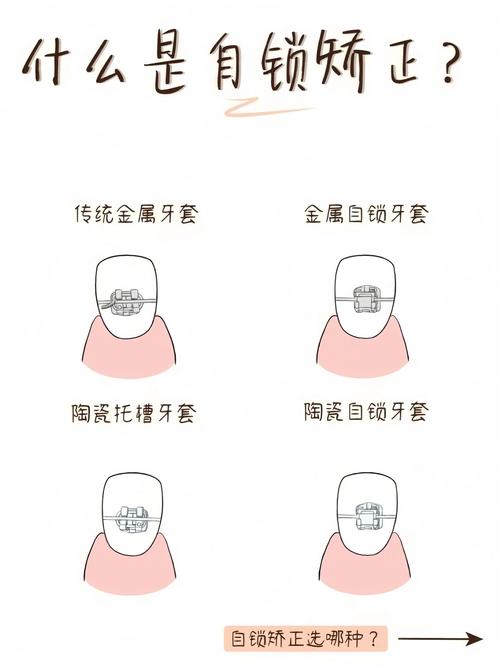 咬合矫正的最佳方法是什么？如何选择适合自己的方案？-图3
