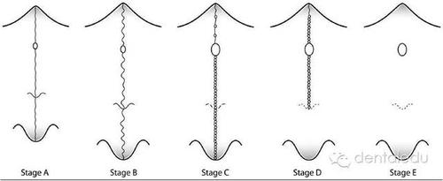 腭中缝扩展的方法有哪些及如何操作?-图1 腭中缝扩展的方法有哪些及如何操作?-图1