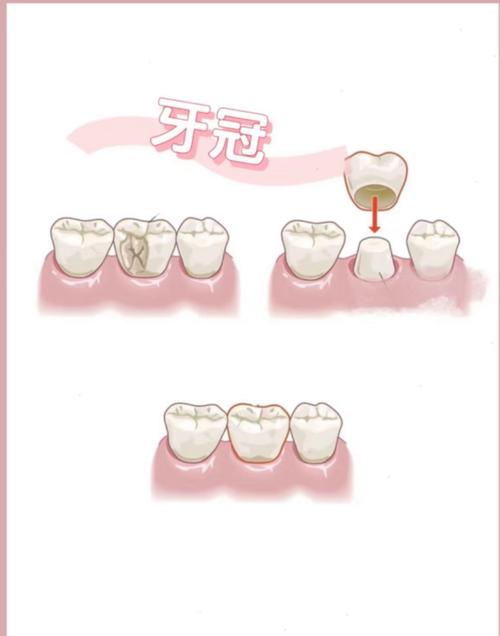 牙齿嵌体修复的方法具体有哪些步骤?-图1 牙齿嵌体修复的方法具体有哪些步骤?-图1