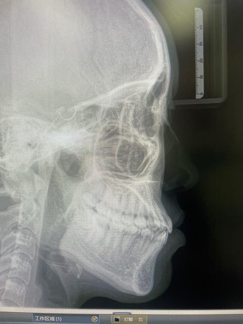 牙齿正畸拍片角度过大会有什么影响？-图2