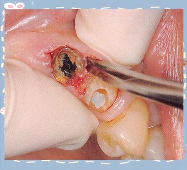 拔残根用什么方法-图1