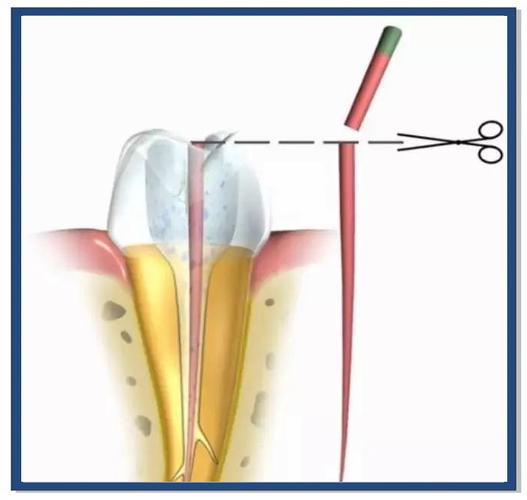 牙尖治疗方法有哪些？如何有效治疗牙尖问题？-图3