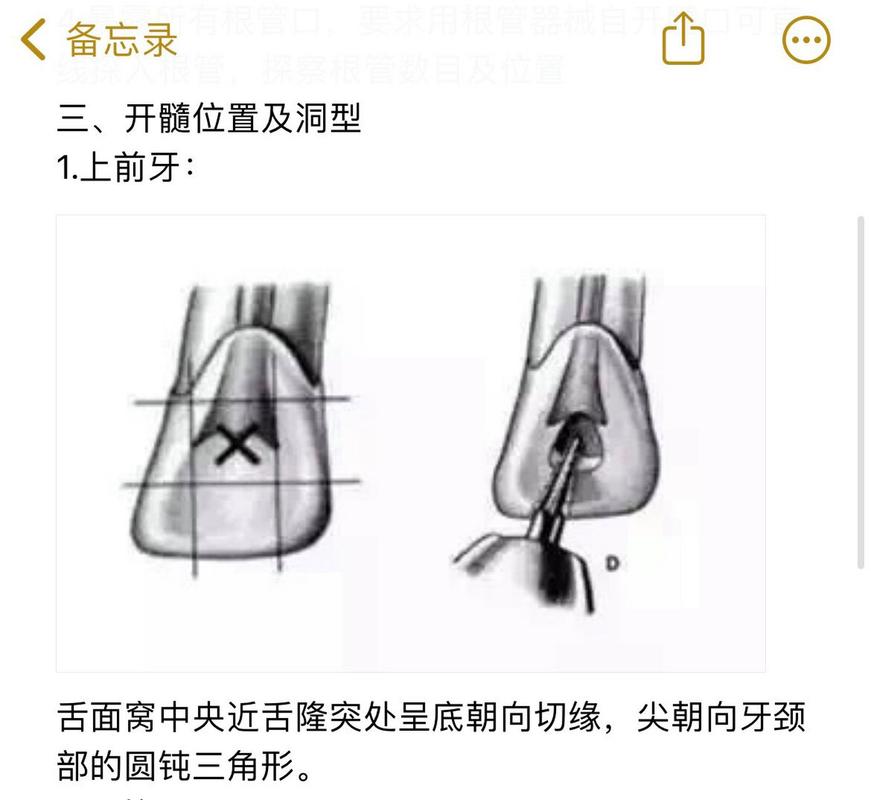 如何精准寻找根管口？关键技巧有哪些？-图3