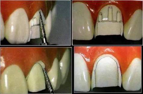 前牙烤瓷备牙的方法有哪些操作要点？-图2