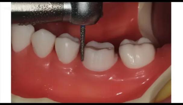 前牙烤瓷备牙的方法有哪些操作要点？-图3