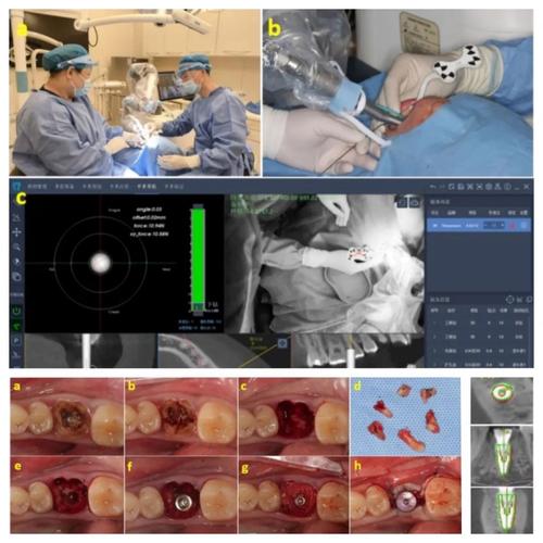 什么是水激光种牙?与传统种牙有何区别?-图1 什么是水激光种牙?与传统种牙有何区别?-图1