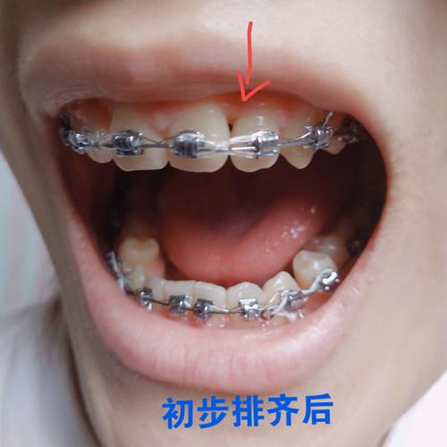 口腔骨尖的治疗方法有哪些？哪种更有效？-图2