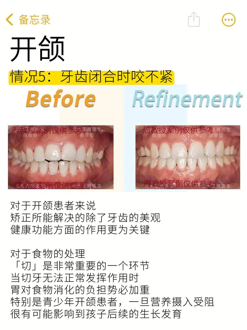咬合不正正畸方法-图1 咬合不正正畸方法-图1