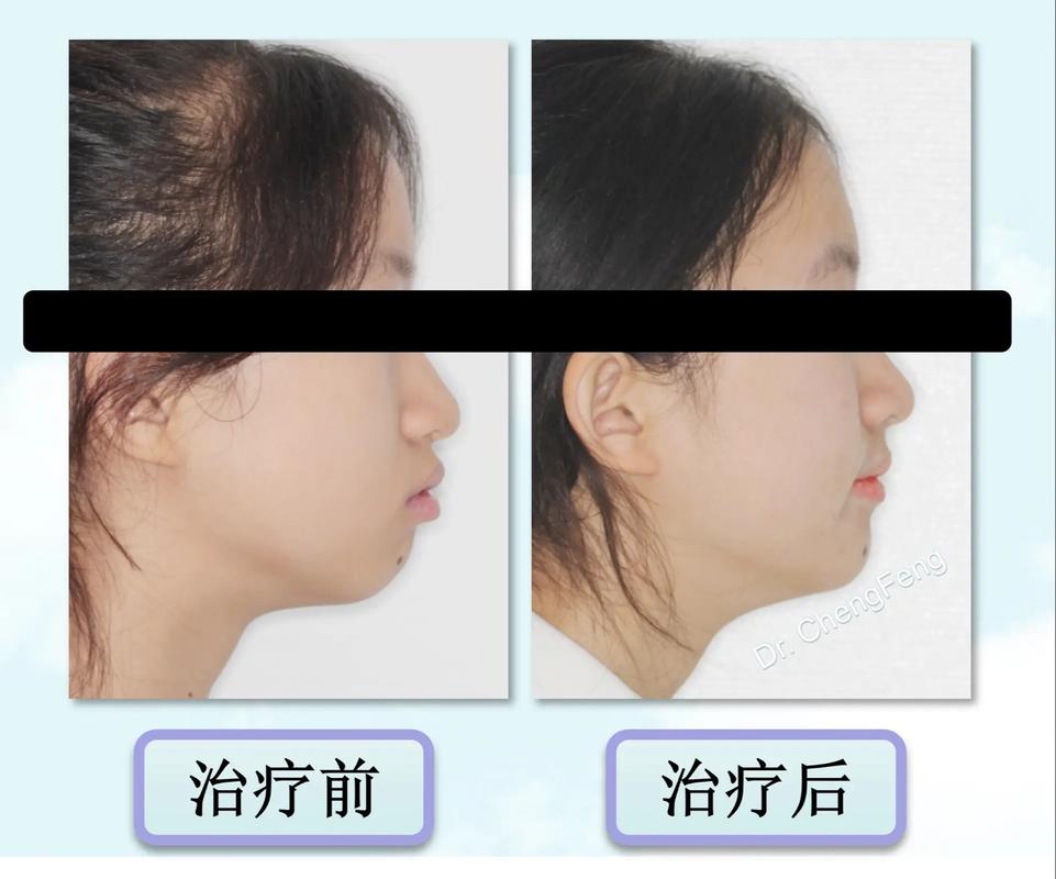 儿童正畸是否必须拔牙？关键看这些情况-图2