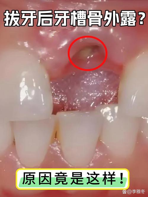 月经期能拔正畸牙吗？有哪些注意事项？-图3