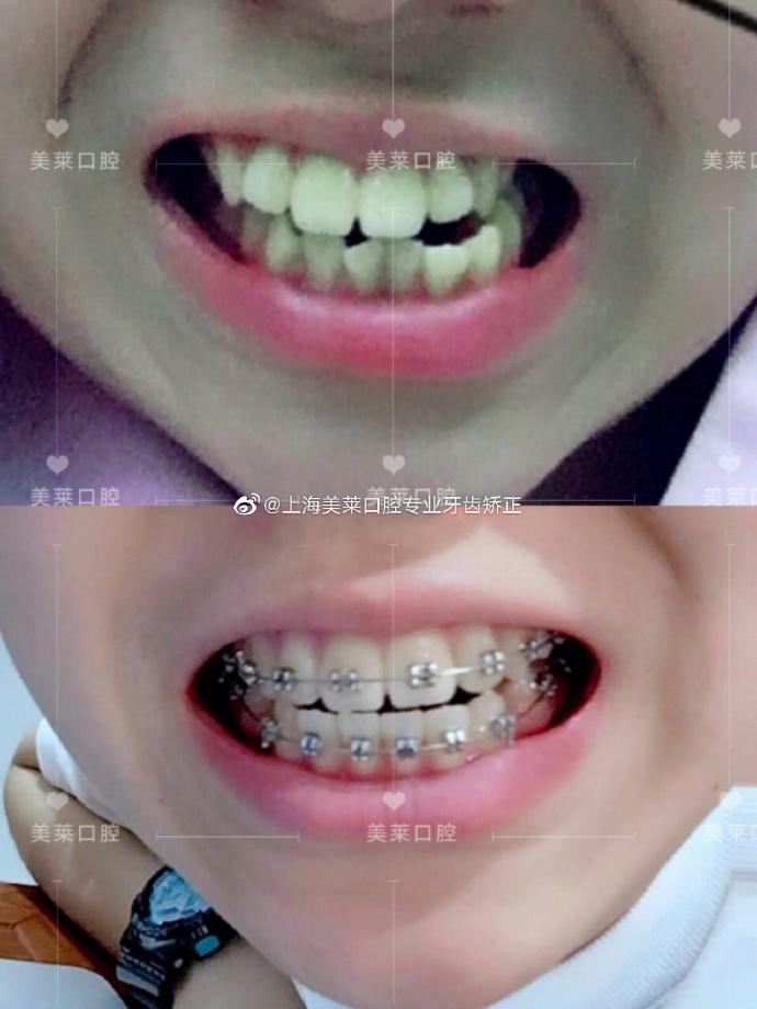 长沙牙齿正畸效果美莱-图2