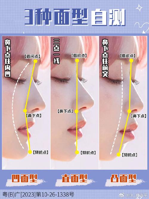正畸侧貌面型分类标准-图2