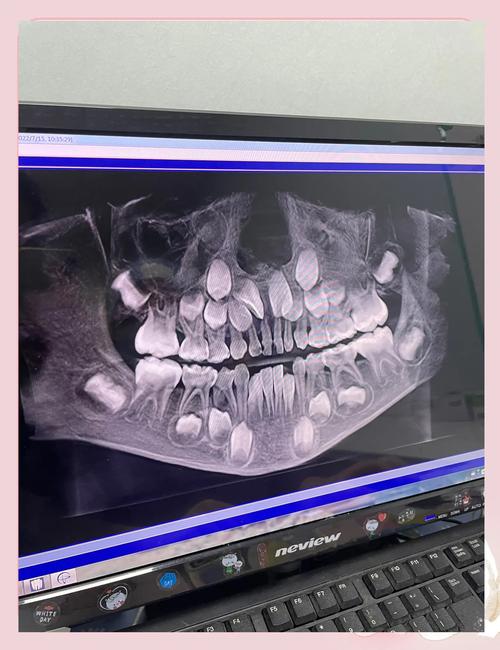 牙齿正畸前，到底要不要做血检？有必要吗？-图1