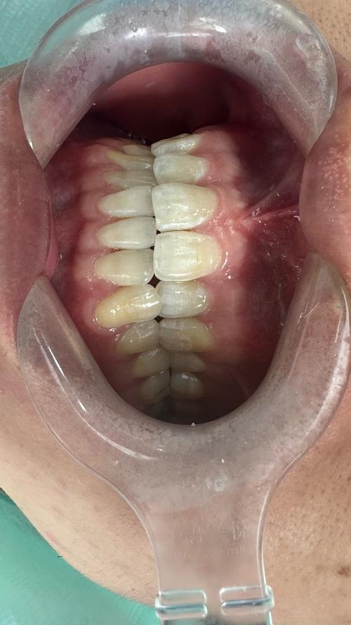 牙齿正畸前，到底要不要做血检？有必要吗？-图2