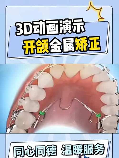 前牙开颌如何有效治疗？方法有哪些？-图3