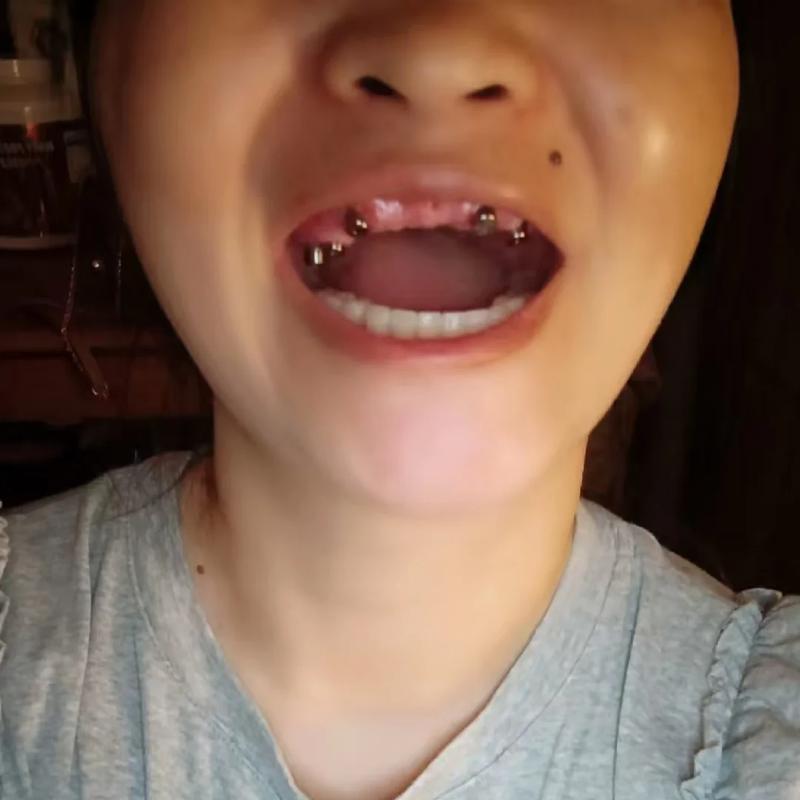 种牙后牙龈形态影响美观,该如何改善?-图1 种牙后牙龈形态影响美观,该如何改善?-图1