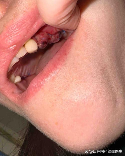 种牙后牙龈形态影响美观，该如何改善？-图3