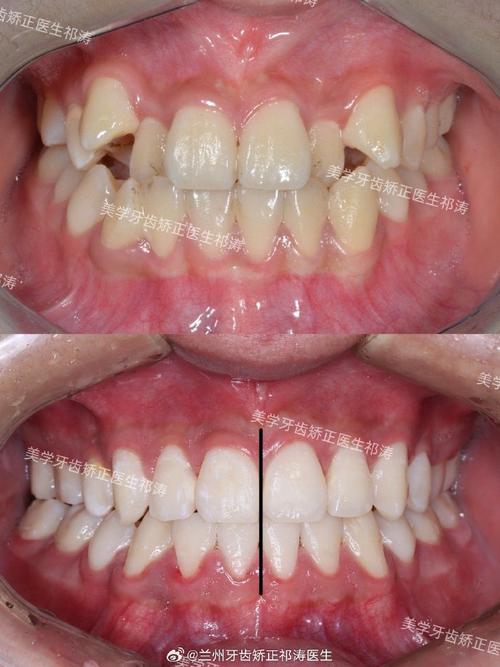 种牙后其他牙齿为何会拥挤？是邻牙移位还是种植体影响？-图2