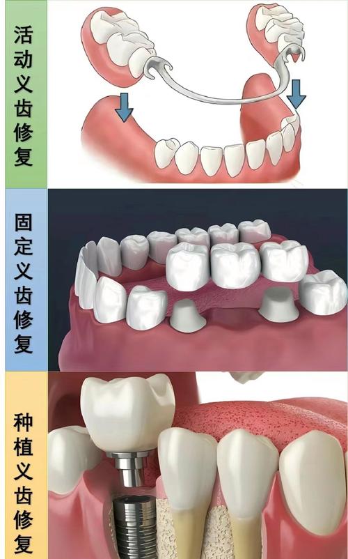 活动义齿调磨方法有哪些实用步骤？-图1