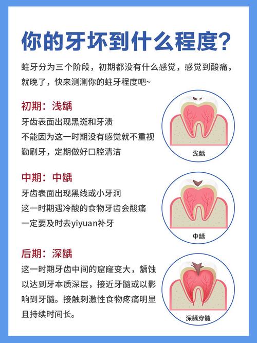成人龋齿如何彻底根治?有哪些有效治疗手段?-图1 成人龋齿如何彻底根治?有哪些有效治疗手段?-图1