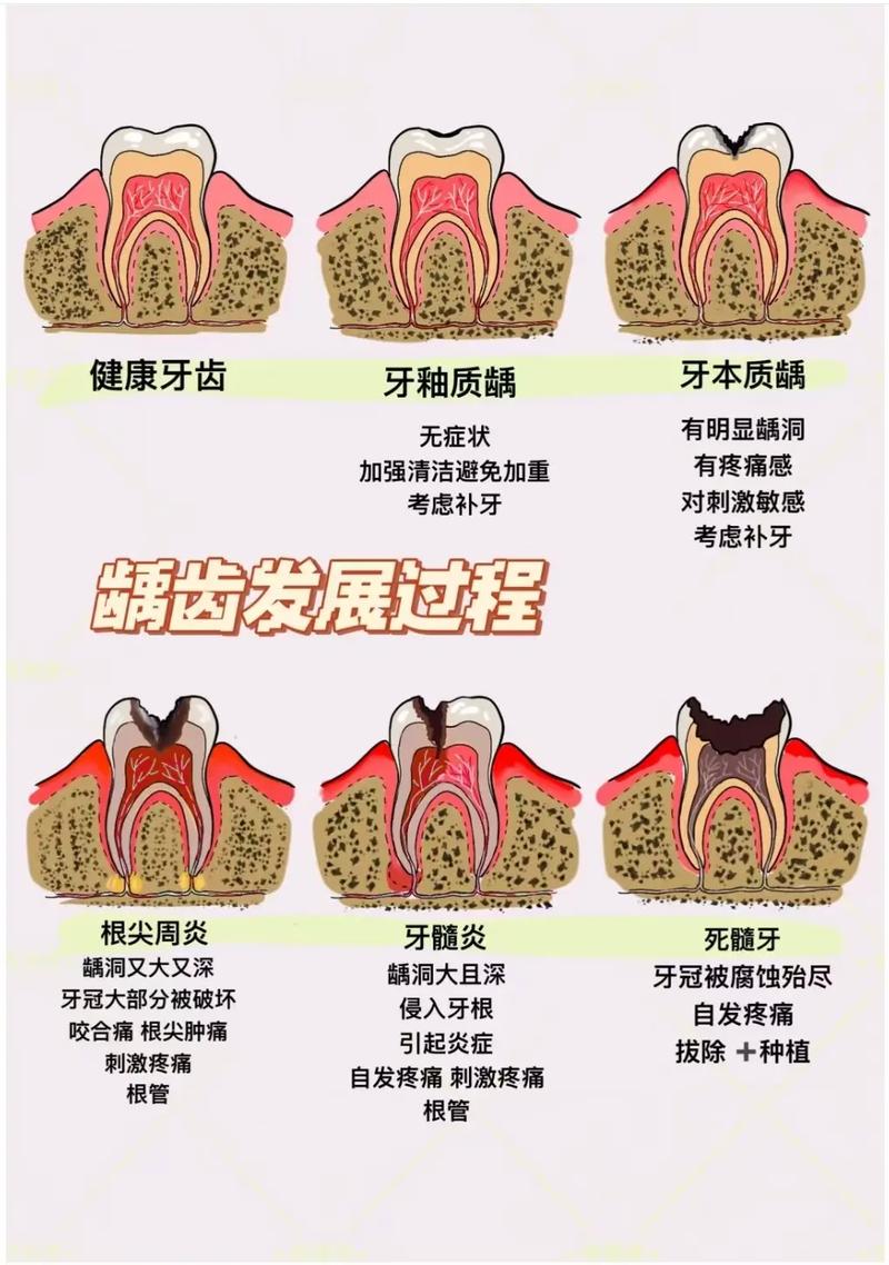 成人龋齿如何彻底根治？有哪些有效治疗手段？-图3