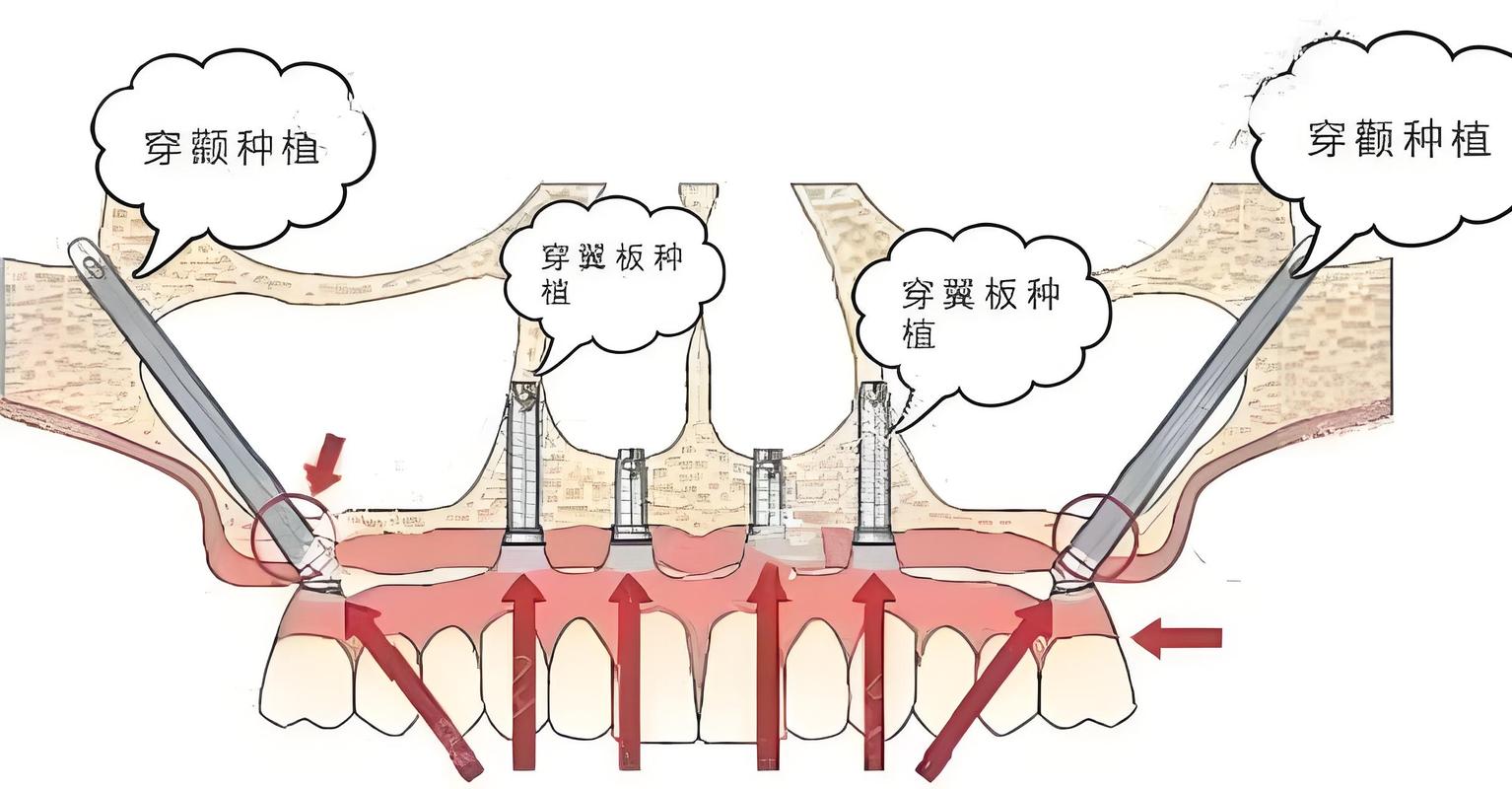自体牙移植是先种牙根还是先种牙冠？-图2