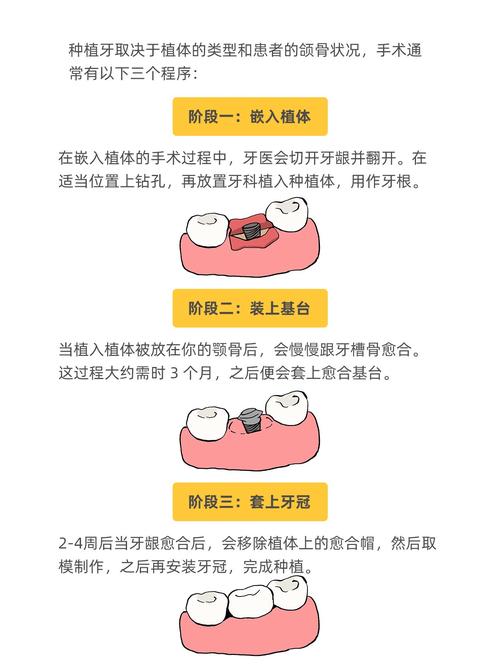 种植牙的详细手术步骤有哪些？想提前了解清楚-图3