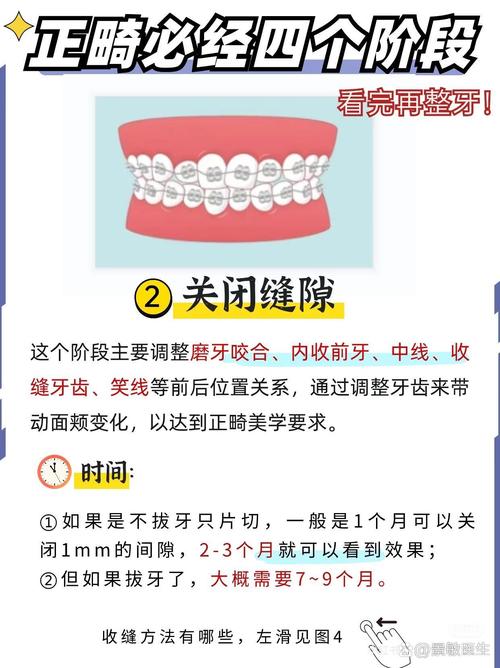 正畸治疗中如何有效预防上颌磨牙前移?-图2 正畸治疗中如何有效预防上颌磨牙前移?-图2