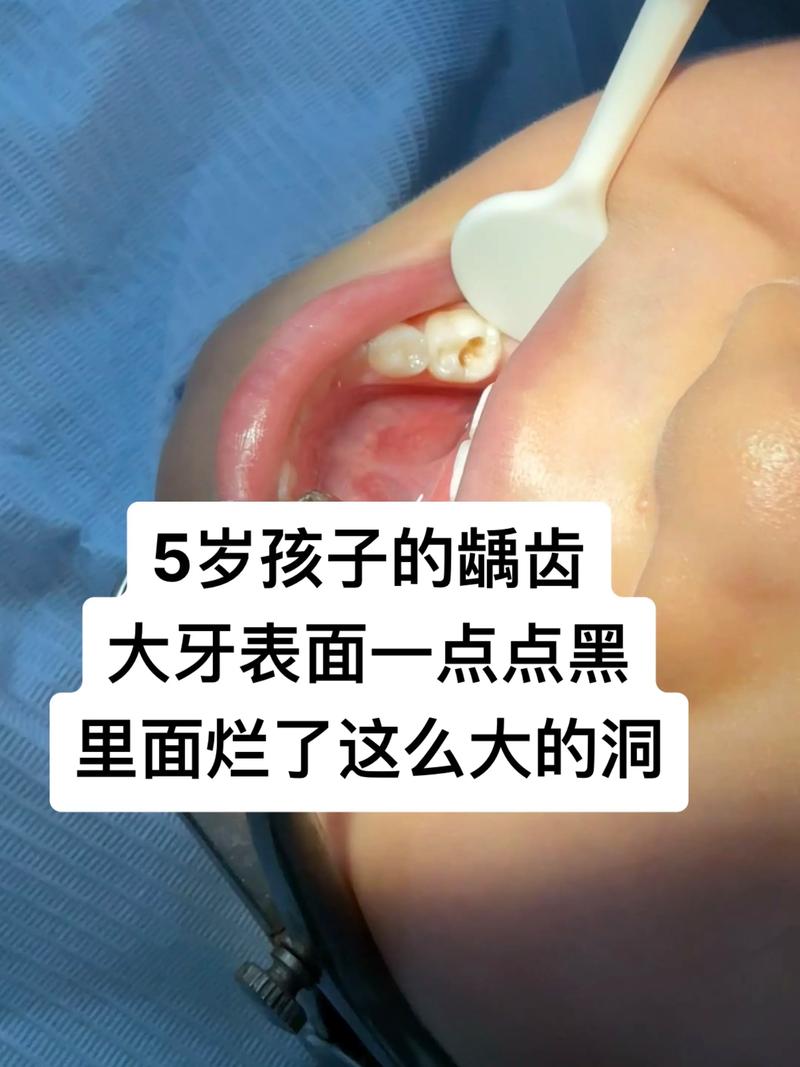 蛀牙发黑怎么办？有哪些有效的处理方法？-图2