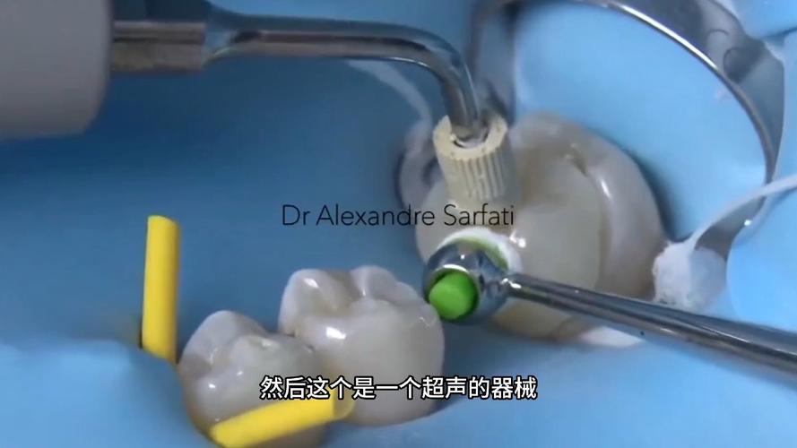 树脂嵌体粘接方法的关键步骤有哪些?-图1 树脂嵌体粘接方法的关键步骤有哪些?-图1