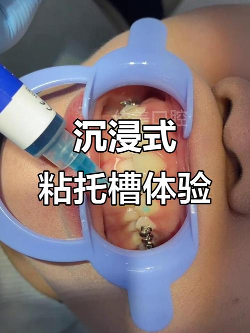 托槽粘接方法视频-图1