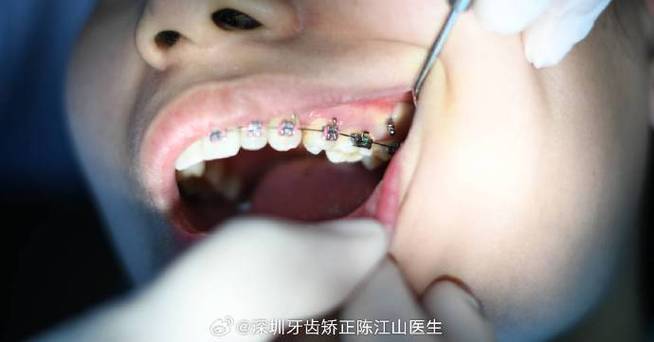 正畸上前牙种植钉的最佳位置如何确定?-图2 正畸上前牙种植钉的最佳位置如何确定?-图2