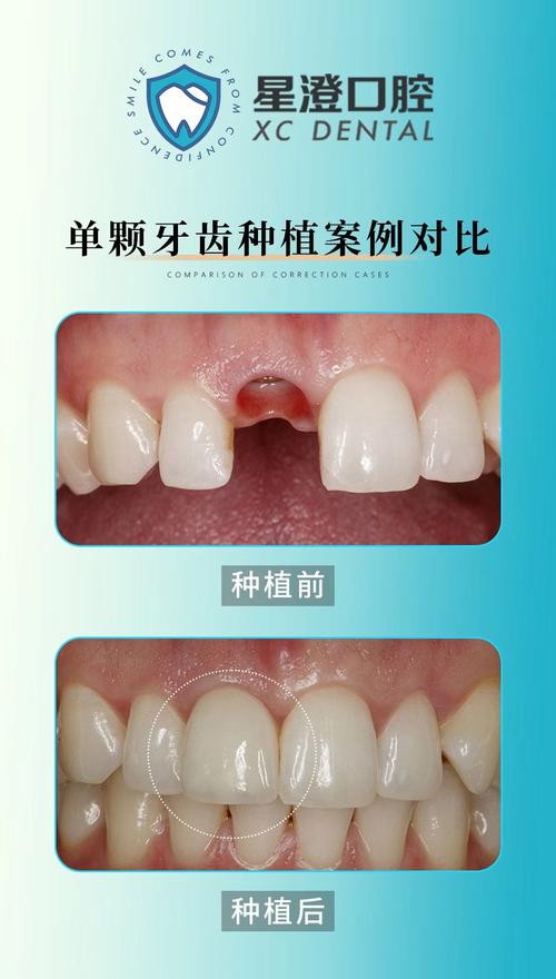 大门牙缺失后种牙好还是做烤瓷牙修复好？-图1