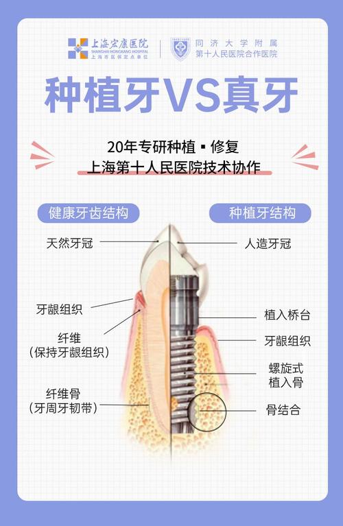大门牙缺失后种牙好还是做烤瓷牙修复好？-图2