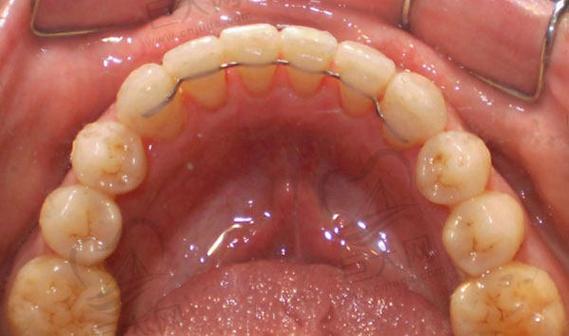 舌侧固定保持器正畸期间具体怎么护理?-图1 舌侧固定保持器正畸期间具体怎么护理?-图1
