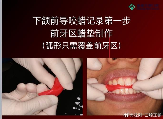 正颌术后如何有效消肿？有哪些实用方法？-图1