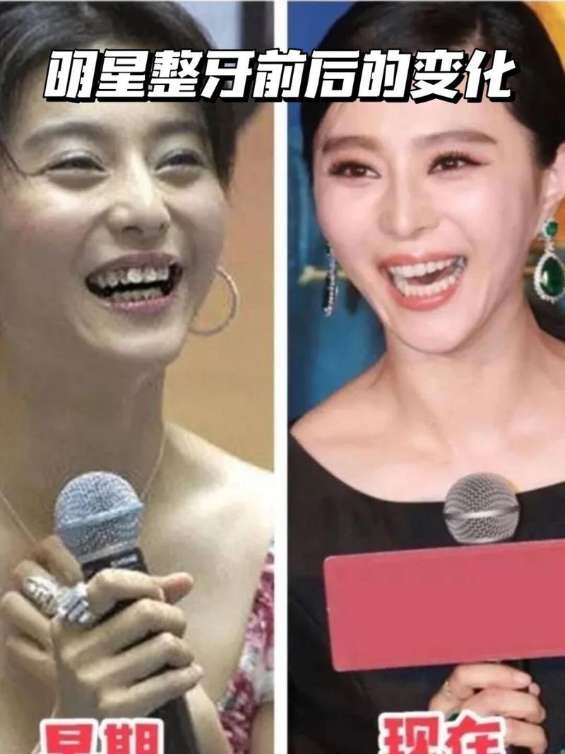 明星正畸前后对比照，颜值逆袭的真相是什么？-图3