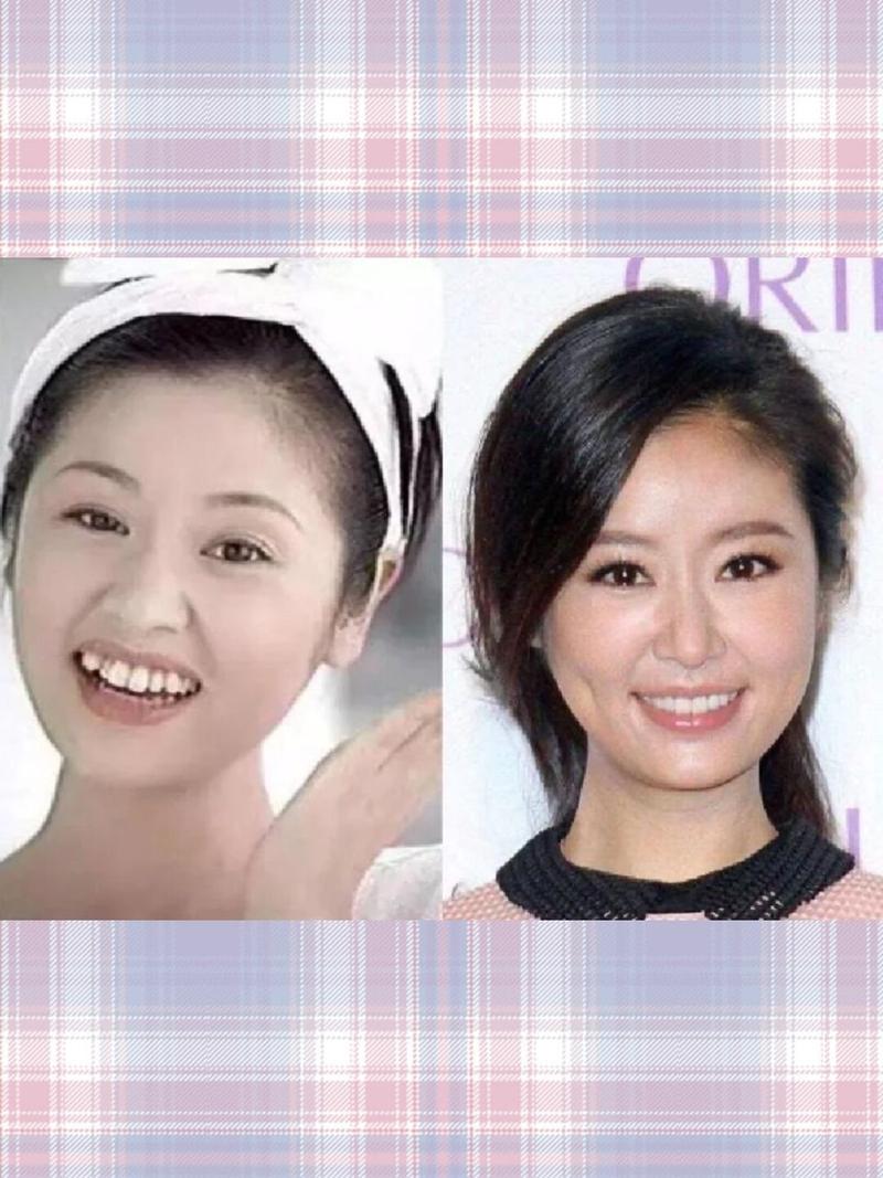 明星正畸前后对比照，颜值逆袭的真相是什么？-图2