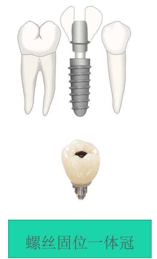 种牙种植冠选哪种好？材质选择有哪些讲究？-图3