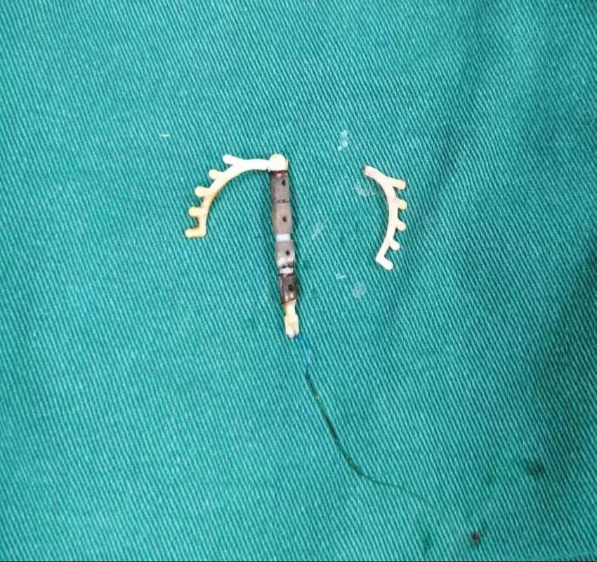 正畸带环上的东西掉了该怎么办?-图2 正畸带环上的东西掉了该怎么办?-图2