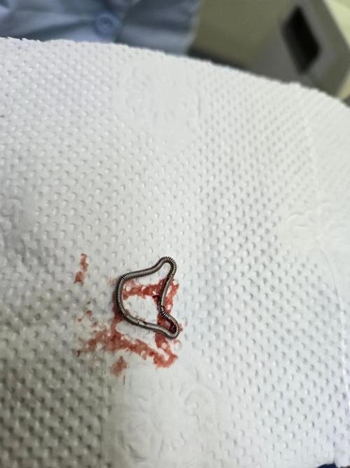 正畸带环上的东西掉了该怎么办?-图1 正畸带环上的东西掉了该怎么办?-图1