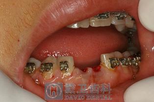 青岛牙科医院种牙多少钱？效果和口碑如何？-图2