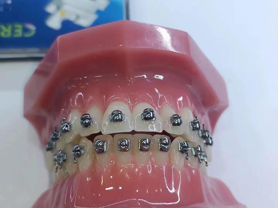 正畸牙科自锁托槽图片展示哪些关键信息？-图3