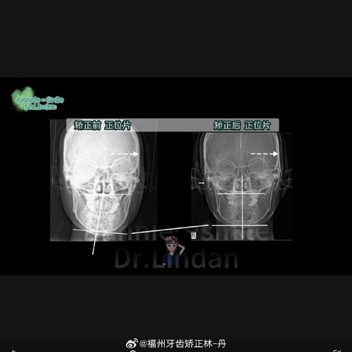 正畸后为何会出现颞颌关节紊乱问题？-图3
